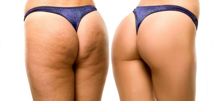 целлюлит на бедрах и ягодицах