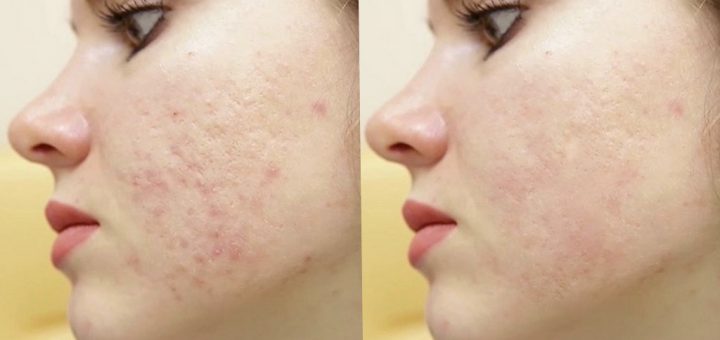 Убрать следы от акне