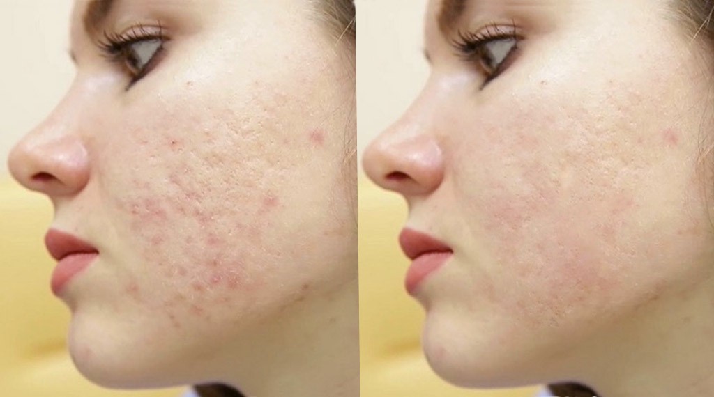 Убрать следы от акне