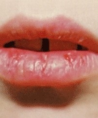 трещины на губах
