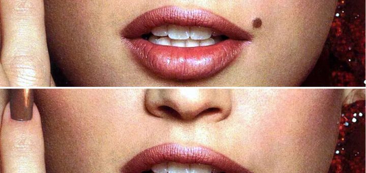 УДАЛЕНИЕ РОДИНОК