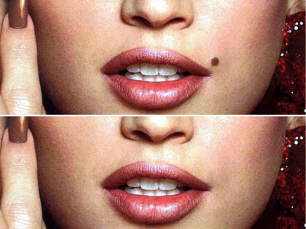 УДАЛЕНИЕ РОДИНОК