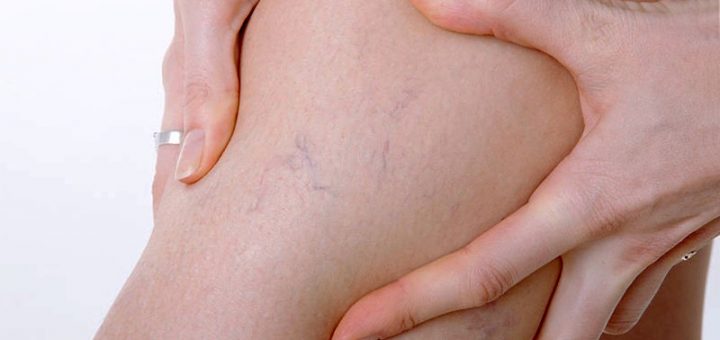 варикозное расширение вен