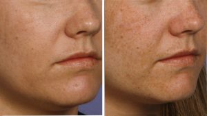 Фракционный фототермолиз