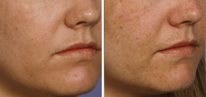 Фракционный фототермолиз