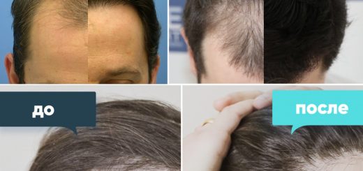 пересадка волос