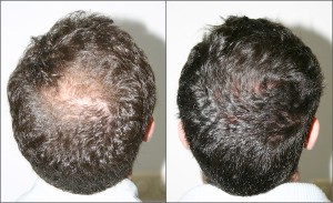 Имплантация и трансплантация волос