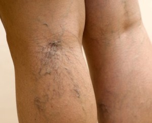 варикозное расширение вен