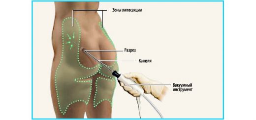 липосакция проблемных зон