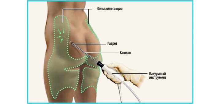 липосакция проблемных зон