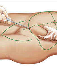 Хирургическая липосакция