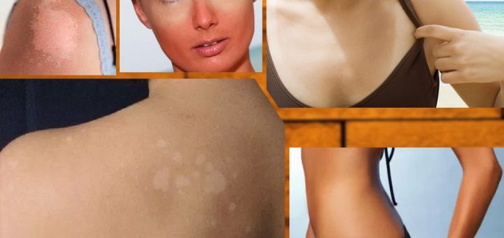 неравномерный загар