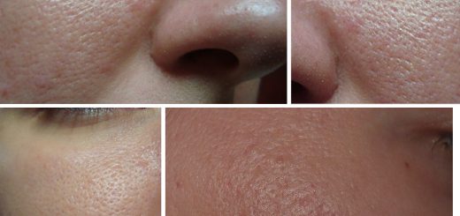 расширенные поры