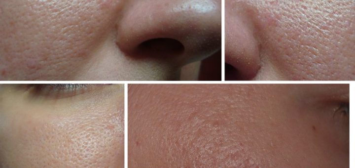 расширенные поры