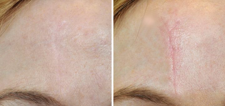 удаление рубцов до и после