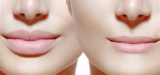 Увеличение губ хирургически