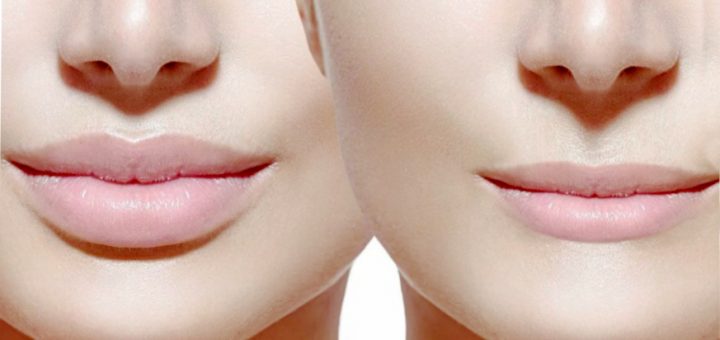 Увеличение губ хирургически