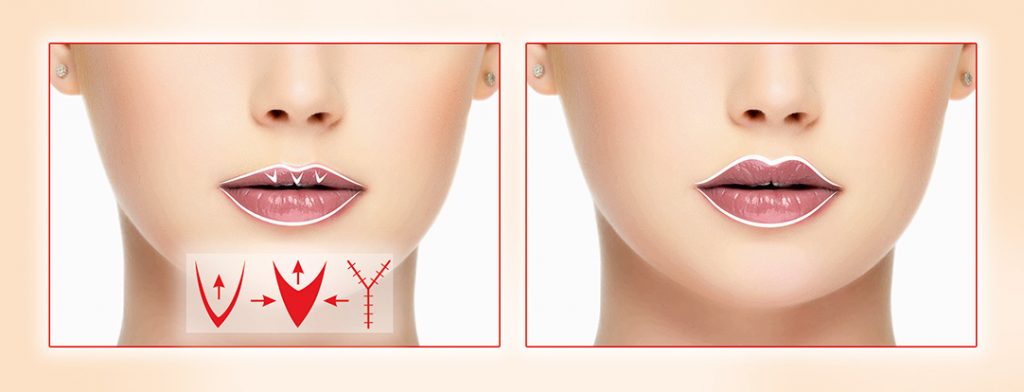 V-Y-пластика губ