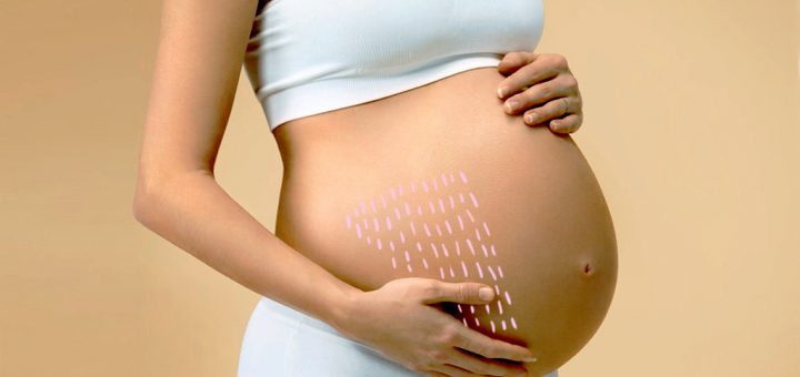 растяжки во время беременности