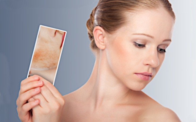 Себорейный дерматит