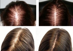 плазмотерапия при лечении алопеции