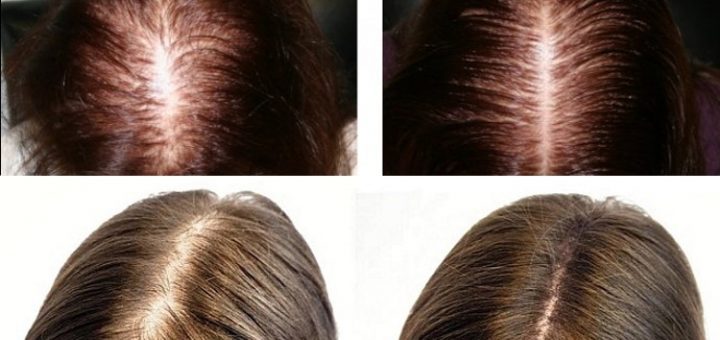 плазмотерапия при лечении алопеции