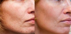 Новогодний фраксель