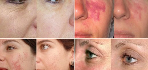 омоложение лазером