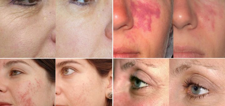 омоложение лазером