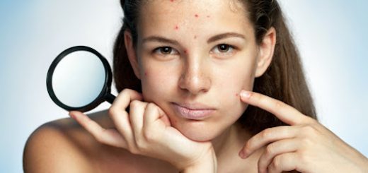 Борьба против акне
