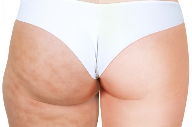 криомассаж против целлюлита