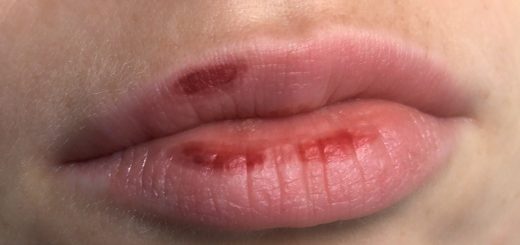 корочки на губах хейлит