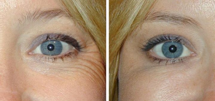 мезотерапия для лица