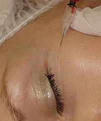 Мезотерапия вокруг глаз