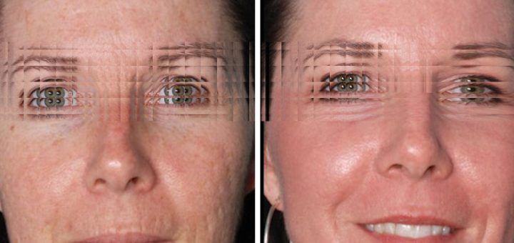 результат шлифовки лица