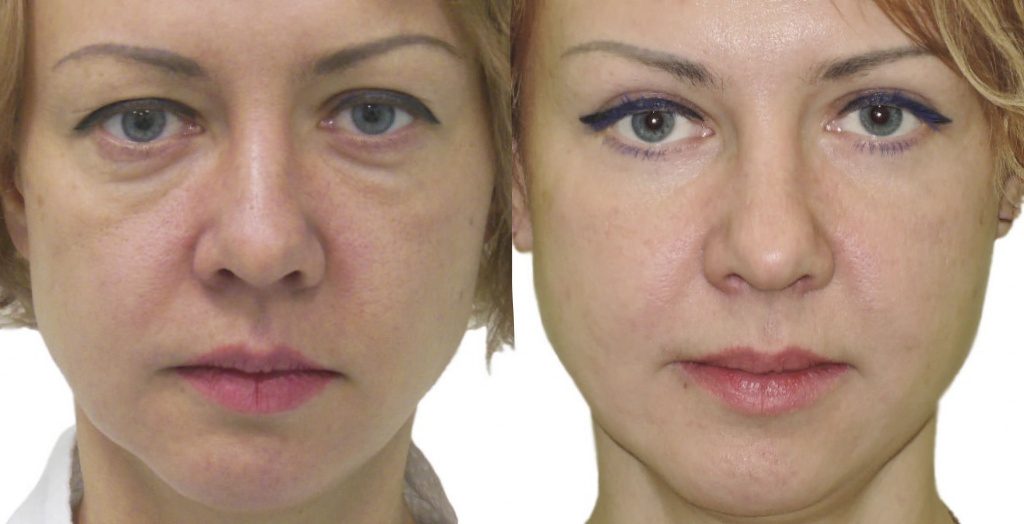 блефаропластика век