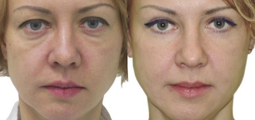 блефаропластика век