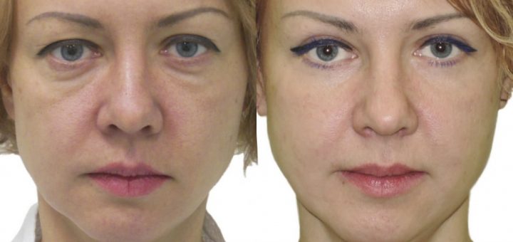 блефаропластика век