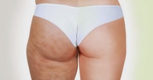 попа с целлюлитом и без