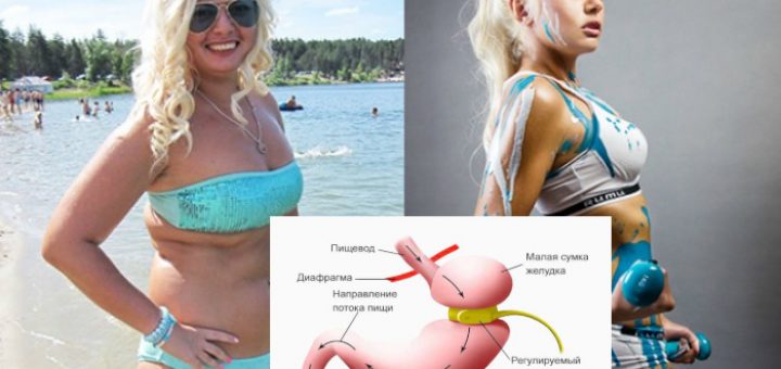 Бандаж желудка или как похудела Ирина Агибалова