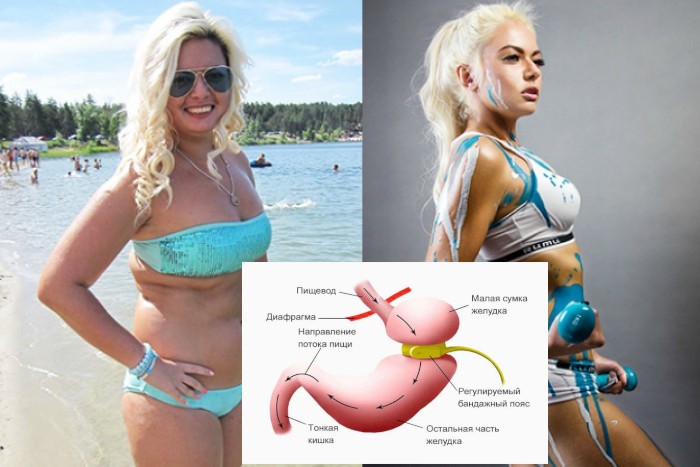 Похудеть с бандажом желудка