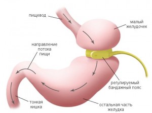 Бандаж желудка