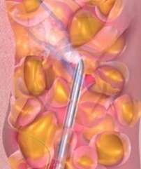 Водоструйная липосакция