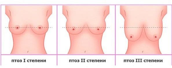 Птоз груди степени