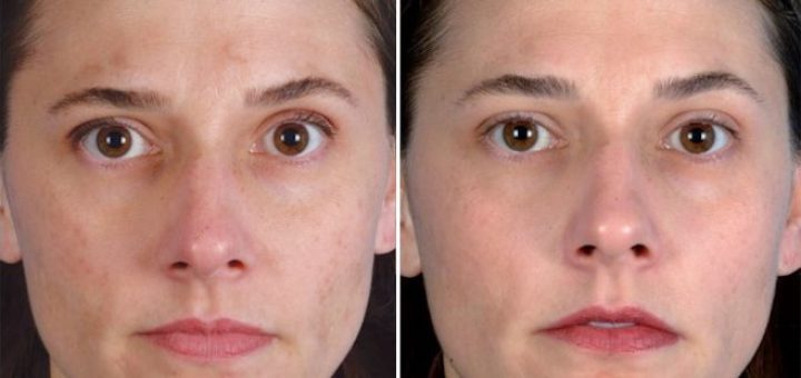 атравматическая чистка лица