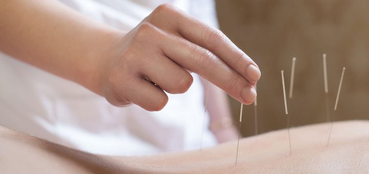 иглоукалывание для похудения