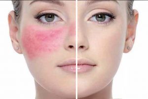 лечение розацеа