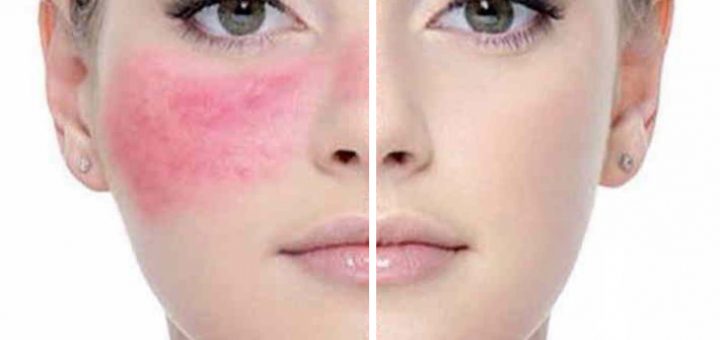 лечение розацеа
