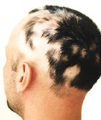 очаговая алопеция