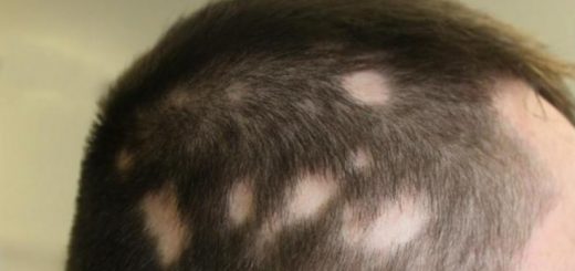 гнездовая алопеция